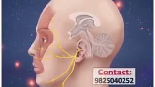 Trigeminal neuralgia treatment radio frequency ablation in ahmedabad gujrat [upl. by Uball927]