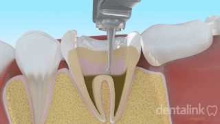 Endodoncia completa PASO A PASO  Video 3D [upl. by Hpesoj624]