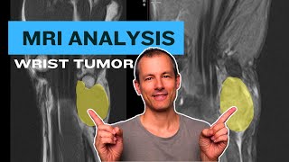 Soft tissue tumor on wrist MRI  interpretation and DDx [upl. by Durarte196]