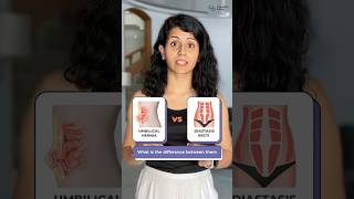 Difference between Umbilical Hernia and Diastasis Recti Postpartum Guide [upl. by Dhu]