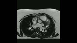 Sinus venosus atrial septal defect [upl. by Werd121]