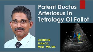 Patent Ductus Arteriosus In Tetralogy Of Fallot [upl. by Ettennan868]