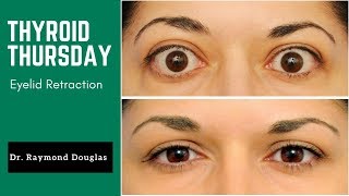 THYROID THURSDAY  Eyelid Retraction in Graves Disease [upl. by Davenport]