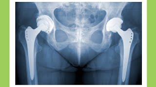 What is Hip Arthroplasty  shorts [upl. by Inimod]