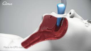 AirQ3®Intubating Laryngeal Airways InService Animation [upl. by Everson611]