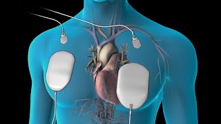 Cardioversion for Atrial Fibrillation [upl. by Aihsemek]