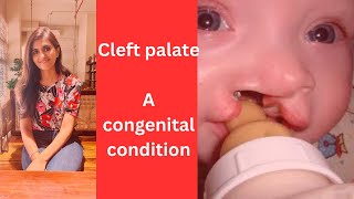 Cleft palate A congenital condition [upl. by Mclain]