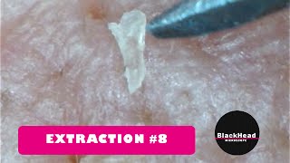 Whitehead and BlackHead RemovalExtraction 8 New One [upl. by Bidget]