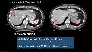 Interpreting CT Abdo Background Liver Hepatic Steatosis High Attenuation Liver [upl. by Kissner]