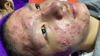 Treatment of acne tablets pustules and blackheads 358  Loan Nguyen [upl. by Iolande226]