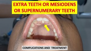 SUPERNUMERARY TEETH MESIODENS EXTRA TEETH COMPLICATIONS AND TREATMENT dentalcafe4331 [upl. by Schuyler]