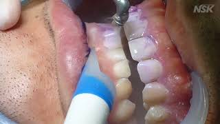 NSK Pero Mate Removing plaque [upl. by Iliak54]