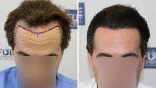 FUE Hair Transplant 2000 Grafts in NW Class 3A By Dr Juan Couto  FUEXPERT CLINIC Madrid Spain [upl. by Whelan]