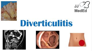 Diverticulitis Risk Factors ex Low Fiber Diets Symptoms Diagnosis Treatment and Complications [upl. by Aid94]