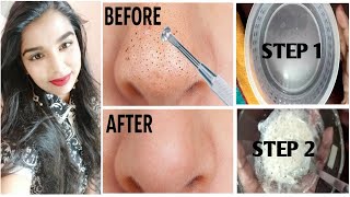 Natural home remedy for removing blackheads amp whiteheads blackheads removal in tamil [upl. by Irod]