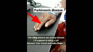 Pillrolling Tremors Parkinsons Disease [upl. by Aleunam]