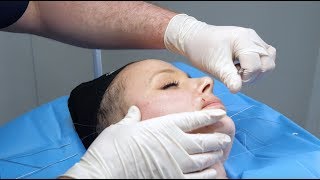 Silhouette Soft ThreadLift  Live Procedure at The Laser and Skin Clinic [upl. by Reld224]