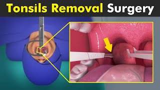 How Tonsillectomy is Performed  Tonsils Removal Surgery [upl. by Chandler25]