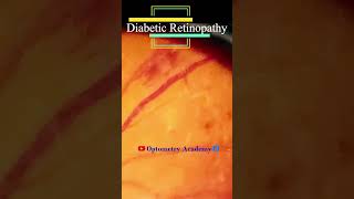 Diabetic retinopathy  Hemorrhages  cotton wool spots  Hard exudates  Fundus  Short Video 174 [upl. by Liris]