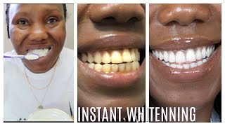 How I whitened my yellow teeth in 2 Minutes  LIVE DEMO HOME REMEDY [upl. by Nutter]