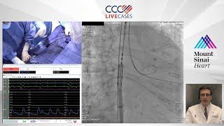 Structural Heart Live Webast Nov 13th 2018  TAVR 29mm Sapien3 [upl. by Storfer]