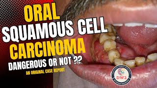 ORAL SQUAMOUS CELL CARCINOMA  HOW DANGEROUS OR LEATHAL IS IT  AN ORIGINAL CASE REPORT PART 1 [upl. by Inesita]