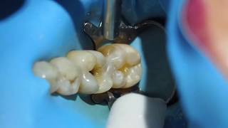 Posterior composite resin restoration Dr Lincoln Harris [upl. by Modla]