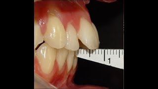 Non Surgical Orthodontic treatment of Skeletal Class II with 7mm Overjet [upl. by Eenahpets]