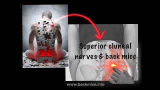 Superior Cluneal Nerve Entrapment and Back Mice two important pieces in the low back pain PUZZLE [upl. by Mungo]