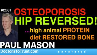 PAUL MASON o2  OSTEOPOROSIS HIP REVERSED …high animal PROTEIN diet restored bone [upl. by Oza]