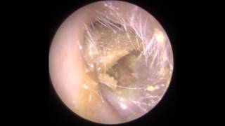 Ear Wax Removal Endoscopic  Clearwax  Ear Wax Removal Specialists [upl. by Ahseikram]