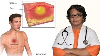 Abscess  Causes Symptoms Treatment in Hindi  फोडा क्यों होता है उसके उपाय [upl. by Namrac412]