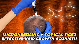 Microneedling  Topical PGE2 – The Most Effective Hair Growth Agonist [upl. by Siuluj]