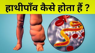 हाथीपाँव फाइलेरिया कैसे होता हैं  Filaria in hindi [upl. by Paula]