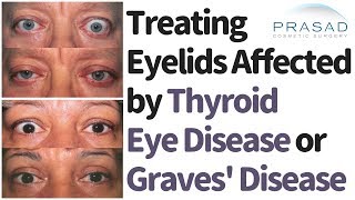 How and When to Treat Eyelids Affected by Graves DiseaseThyroid Eye Disease [upl. by Emyam]