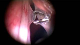 Microlaryngoscopy and removal of a vocal cord cyst [upl. by Waxman]