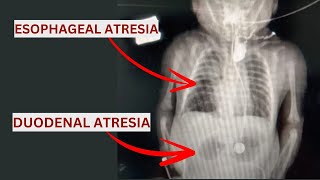 Esophageal Atresia amp Duodenal Atresia Qida borusu və Onikibarmaq bağırsaq Atreziyası [upl. by Erastus]