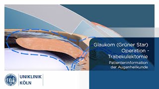 Glaukom Grüner Star OP  Trabekulektomie Patienteninformation Augenklinik  Uniklinik Köln [upl. by Nebuer]