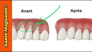 3 remèdes naturels pour réparer les gencives qui se rétractent [upl. by Enaenaj686]