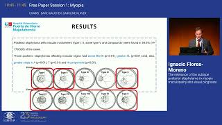 6 The relevance of the subtype posterior staphyloma in myopic maculopathy and visual prognosis [upl. by Lienet]