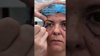 BLEFAROPLASTIE SUPERIOARĂ  INFERIOARĂ Chirurg Plastician amp Estetician Doctor Levy România [upl. by Thema]