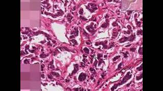 Histopathology LungBronchial carcinoid [upl. by Olecram948]