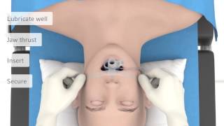 LMA ® Protector ™ Airway Product Quick Reference [upl. by Aivek]