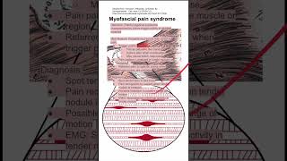 Myofascial pain syndrome [upl. by Gesner527]