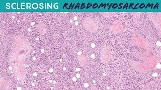 Sclerosing Rhabdomyosarcoma soft tissue pathology sarcoma [upl. by Hairabez]