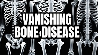 GorhamStout disease vanishing bone disease disappearing bone disease phantom bone disease [upl. by Dusty]