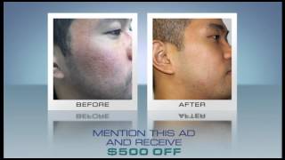 Get Rid of Acne Scars at South Coast MedSpa Vietnamese [upl. by Glanville]