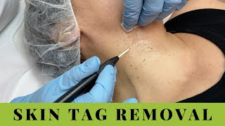 Skin Tags Removal on Neck and Underarms Quick easy no pain [upl. by Esil986]