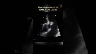 Vegetation at Mitral Valve echo shorts shortsvideo heartcondition [upl. by Eiramnaej]