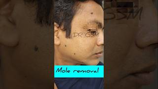 Mole removal drgsmukherjee moleremoval dermatologist laserclinic [upl. by Alaric]